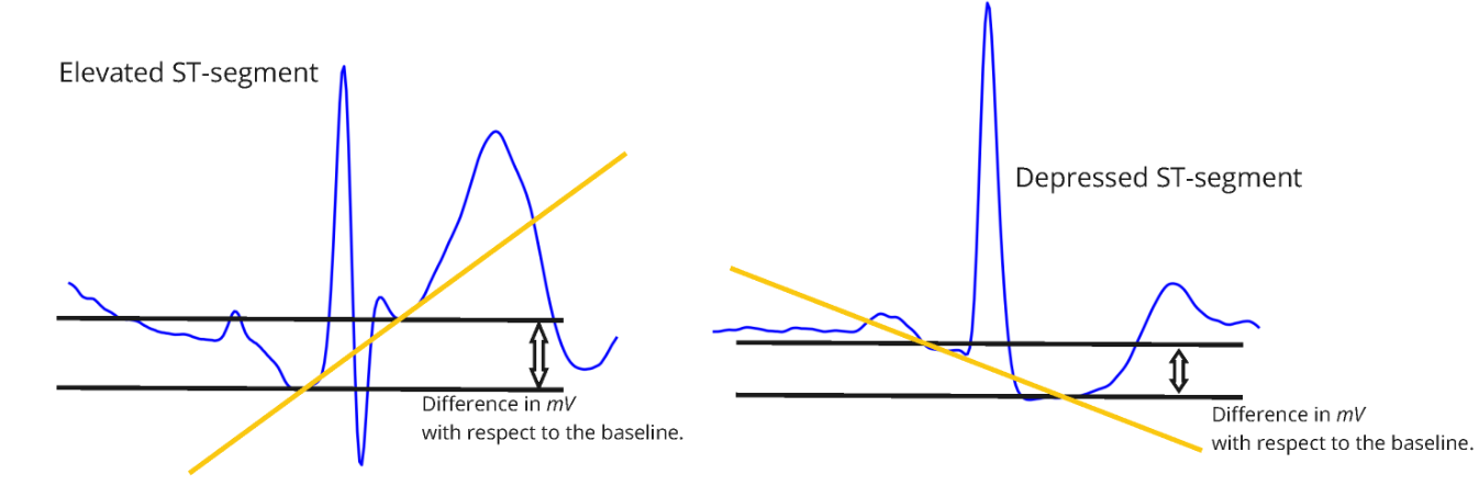 Interpretable Assessment of ST-Segment Deviation in ECG Time Series